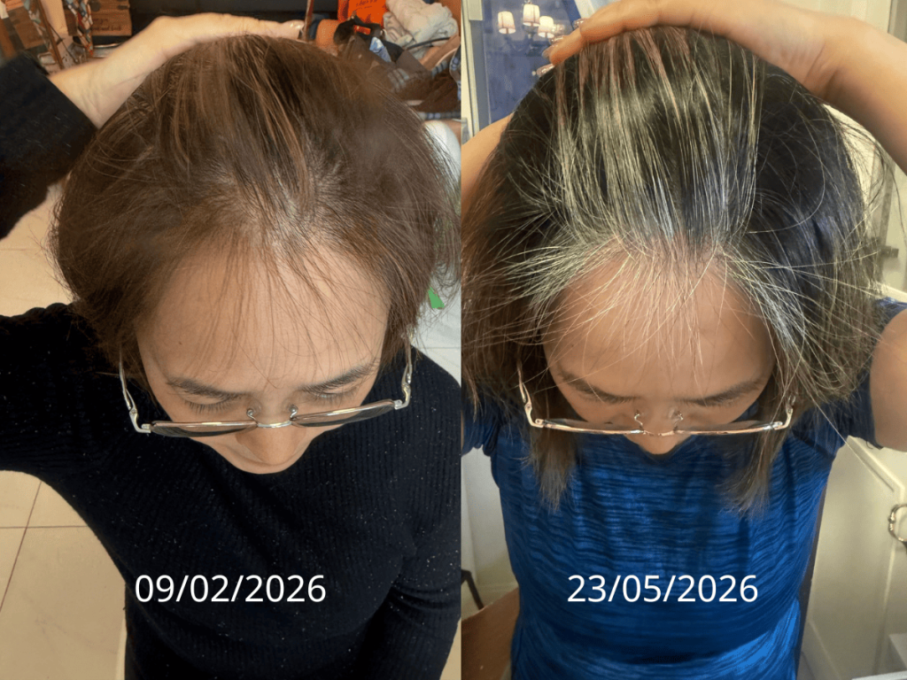 D'REVIVER頭髮稀疏變得濃密 真實照片同一個人 不是Ai成生的
