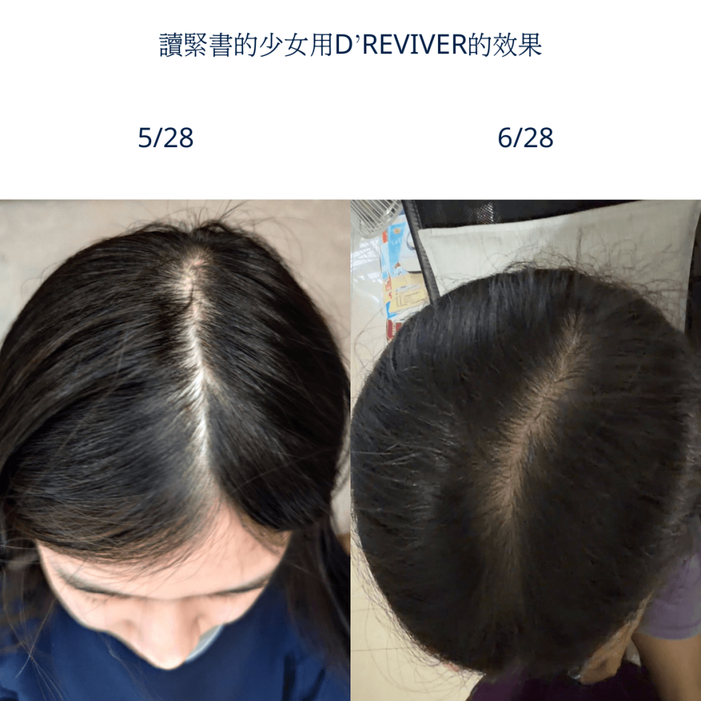 少女用DREVIVER1個月有改善 1